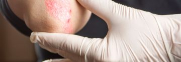 Patient with Psoriasis